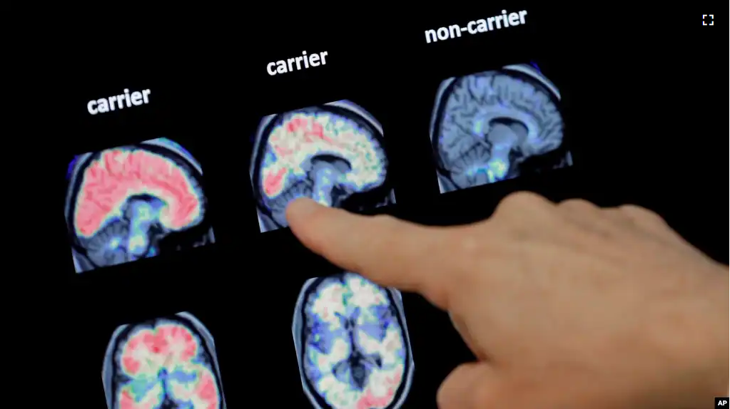 FILE - In this Aug. 14, 2018 file photo, a doctor looks at a PET brain scan at the Banner Alzheimers Institute in Phoenix. (AP Photo/Matt York, File)