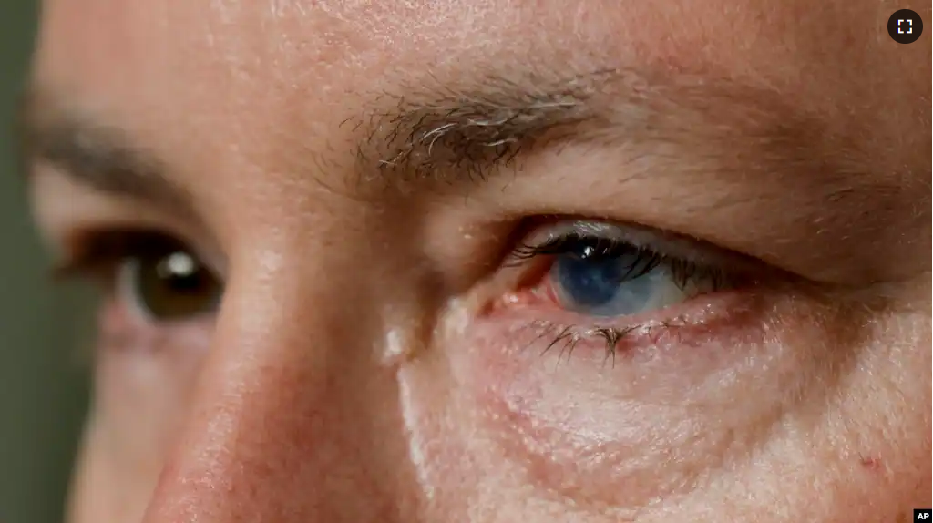 Phil Durst, who has undergone an experimental stem cell procedure with his eyes, sits for a portrait in Homewood, Alabama, on Tuesday, Aug. 15, 2023. (AP Photo/Butch Dill)