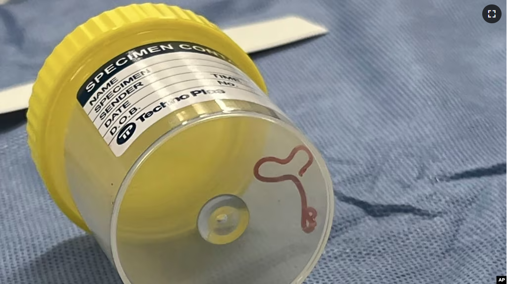 This undated photo supplied by Canberra Health Services, shows a parasite in a specimen jar at a Canberra hospital in Australia. A neurosurgeon investigating a patient's mystery neurological symptoms pulled the worm from her brain. (Canberra Health Services via AP)