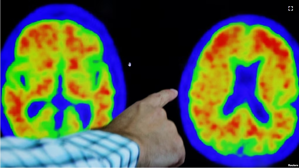 FILE - A doctor points out evidence of Alzheimer's disease on PET scans at the Center for Alzheimer Research and Treatment (CART) at Brigham And Women's Hospital in Boston, Massachusetts, U.S., March 30, 2023. (REUTERS/Brian Snyder)