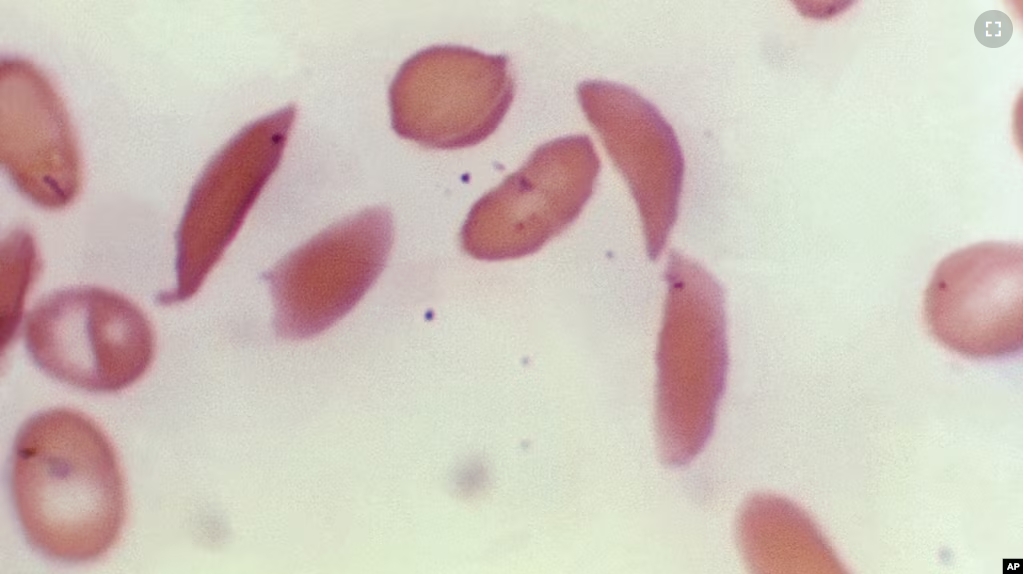 FILE - This photo provided on Oct. 25, 2023 by the Centers for Disease Control and Prevention shows crescent-shaped red blood cells from a sickle cell disease patient in 1972. (Dr. F. Gilbert/CDC via AP, File )