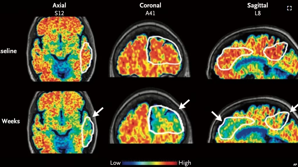 These PET scan images provided by the New England Journal of Medicine in January 2024 show a reduction in amyloid-beta levels in an Alzheimer's patient after focused ultrasound treatment to open the blood-brain barrier after 26 weeks. (New England Journal of Medicine via AP)