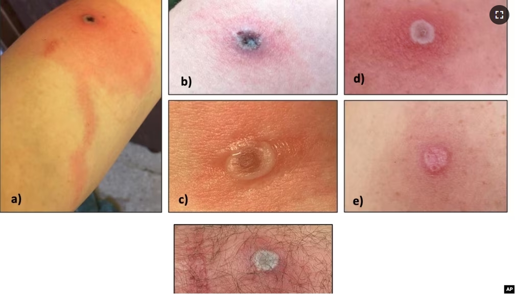 This image provided by the Alaska Department of Health shows several Alaskapox lesions. (Alaska Department of Health via AP)