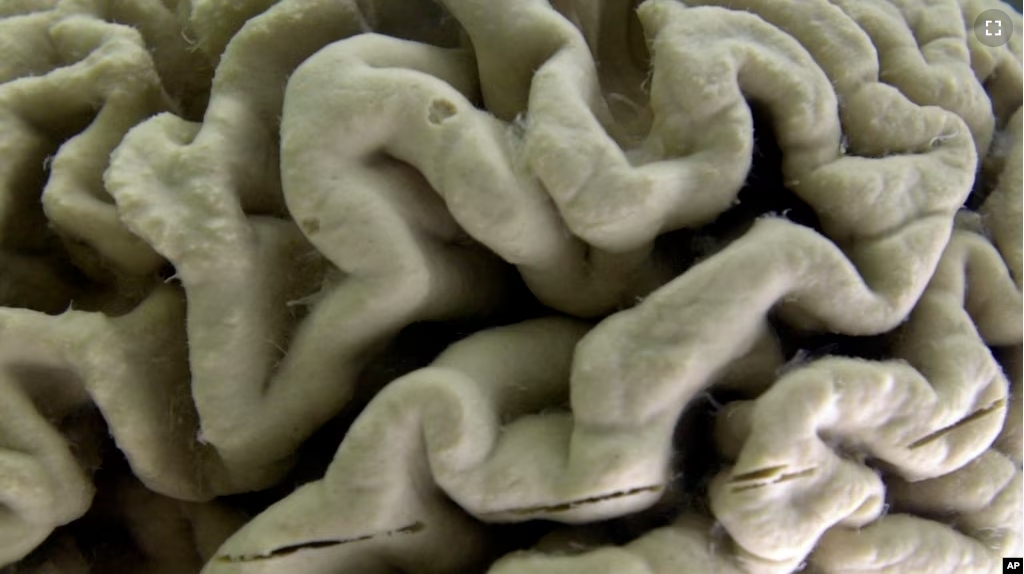 FILE - A closeup of a human brain affected by Alzheimer's disease, is displayed at the Museum of Neuroanatomy at the University at Buffalo in Buffalo, New York, in 2003. (AP Photo/David Duprey)