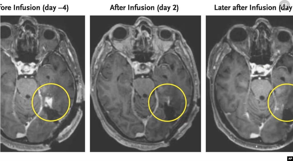 This combination of MRI scan images provided by the New England Journal of Medicine in March 2024 shows the progress of a glioblastoma patient who received CAR-T therapy which uses modified versions of T cells from a patient's own immune system. (NEJM via AP)