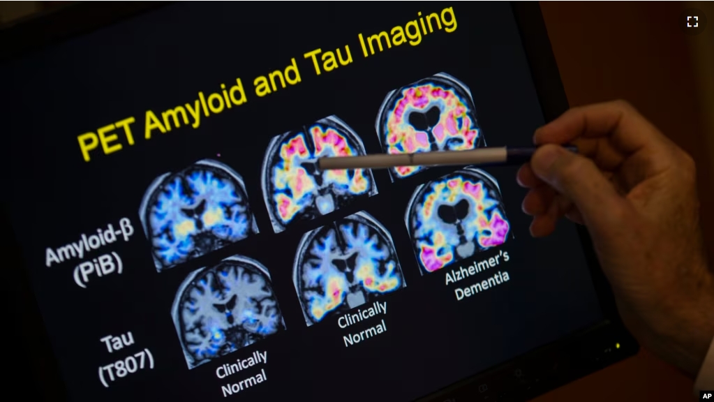 FILE - A doctor points to PET scan results that are part of a study on Alzheimer's disease at Georgetown University Hospital, on Tuesday, May 19, 2015, in Washington. (AP Photo/Evan Vucci, File)