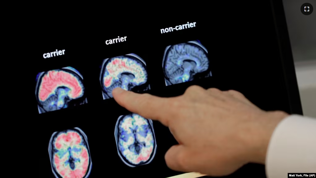 FILE - A doctor looks at PET brain scans at Banner Alzheimers Institute in Phoenix on Aug. 14, 2018.